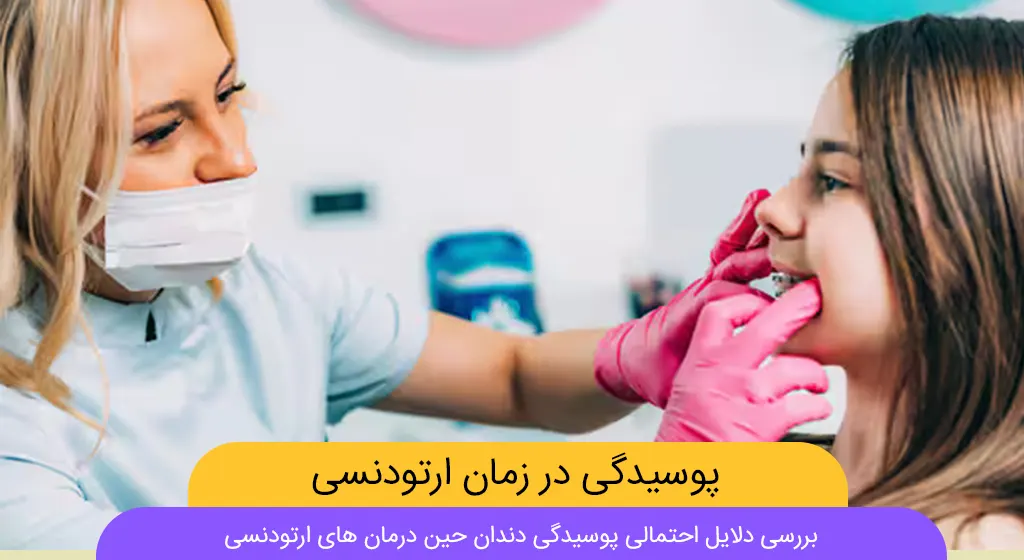 پوسیدگی دندان حین درمان ارتودنسی شاخص