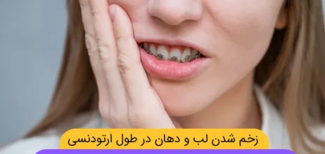 زخم شدن لب و دهان در طول ارتودنسی شاخص