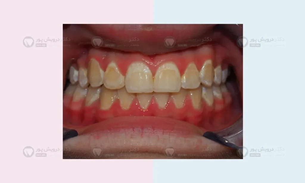 لکه های سفید روی دندان ها