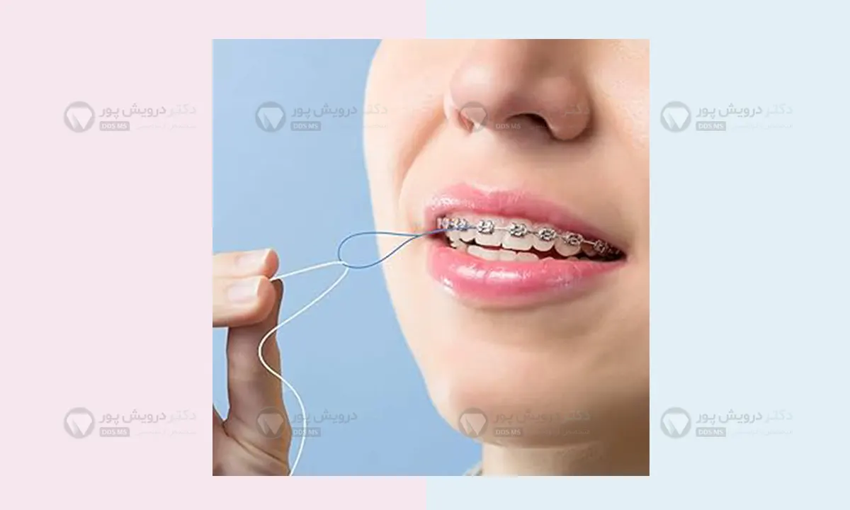 نخ دندان ارتودنسی