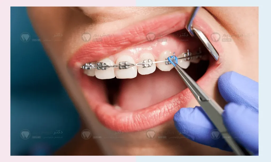 نصب وسایل ارتودنسی