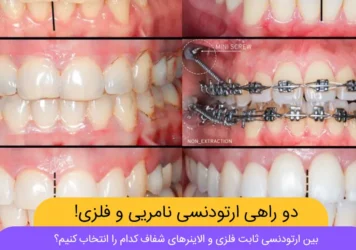 ارتودنسی فلزی یا الاینر شفاف شاخص
