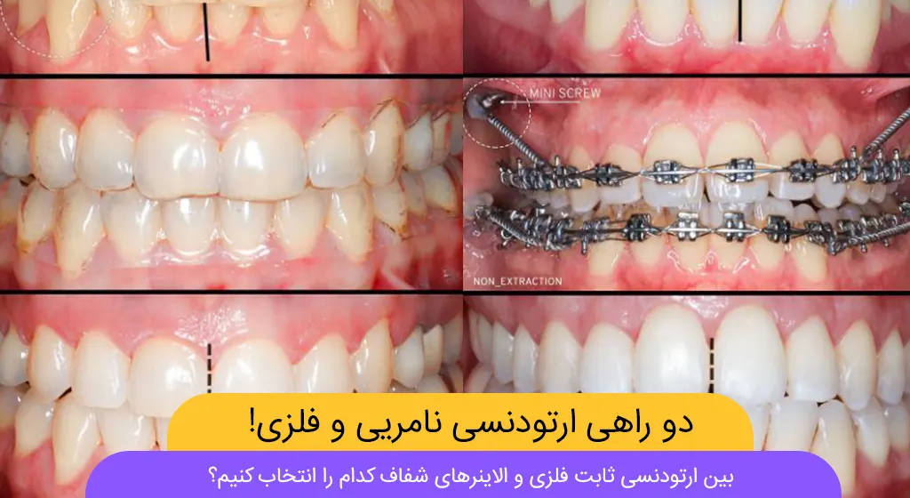 ارتودنسی فلزی یا الاینر شفاف شاخص
