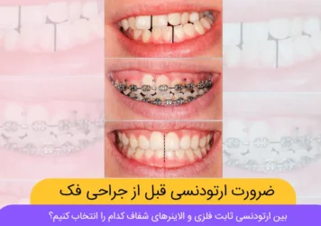 ارتودنسی قبل از عمل جراحی فک شاخص