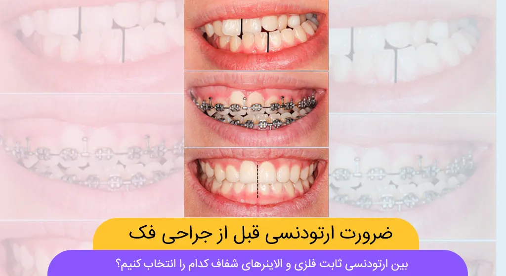 ارتودنسی قبل از عمل جراحی فک شاخص