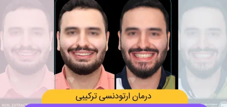 ارتودنسی ترکیبی شاخص
