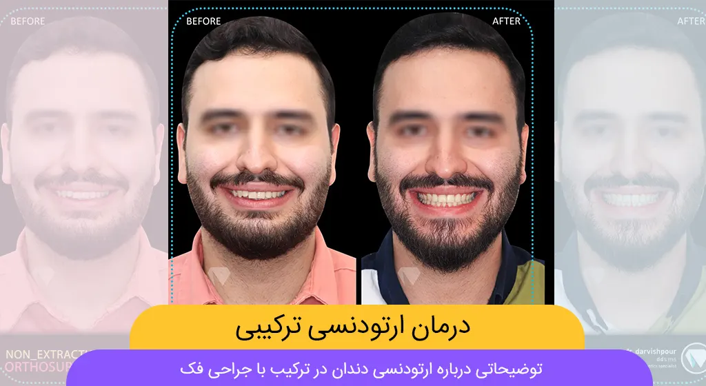 ارتودنسی ترکیبی شاخص