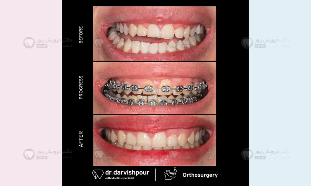 قبل و بعد از درمان ارتودنسی ثابت