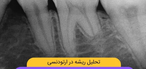 تحلیل ریشه در ارتودنسی