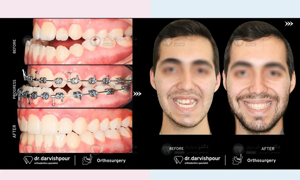 قبل و بعد از ارتودنسی 