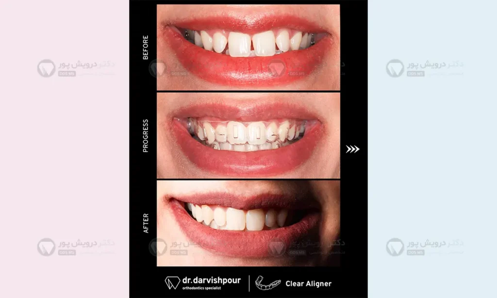 اتچمنت های مستطیلی