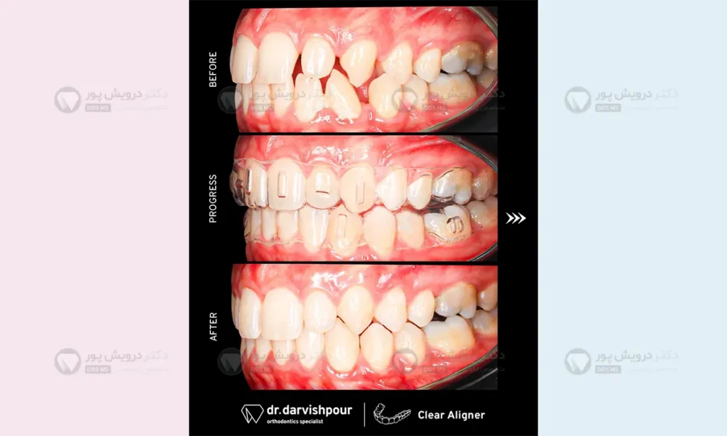 اتچمنت گذاری اصولی