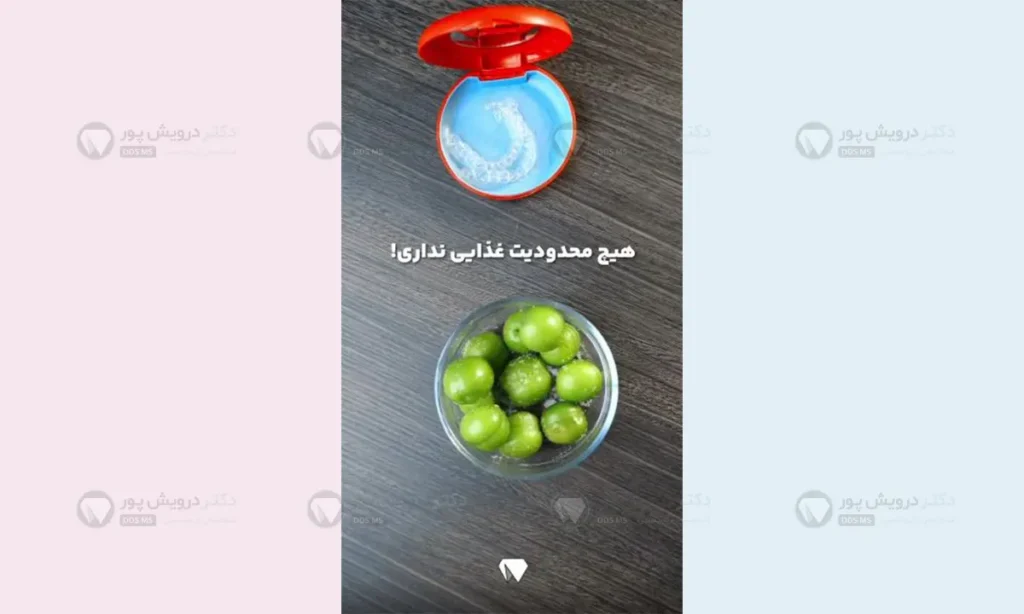 محدودیت غذایی با الاینرهای شفاف