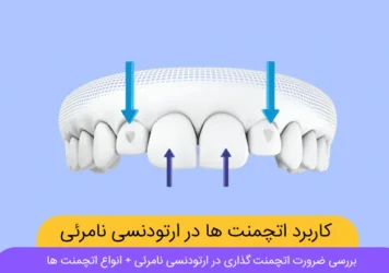 اتچمنت گذاری در ارتودنسی نامرئی شاخص
