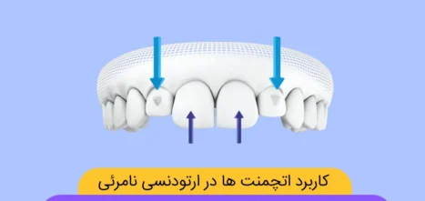 اتچمنت گذاری در ارتودنسی نامرئی شاخص