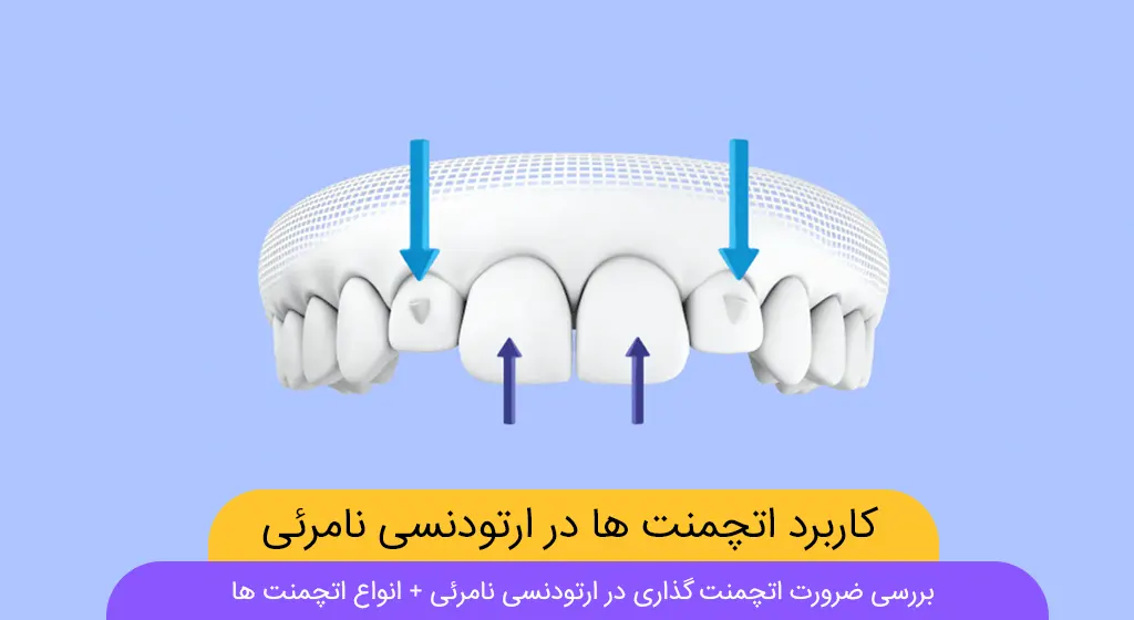 اتچمنت گذاری در ارتودنسی نامرئی شاخص