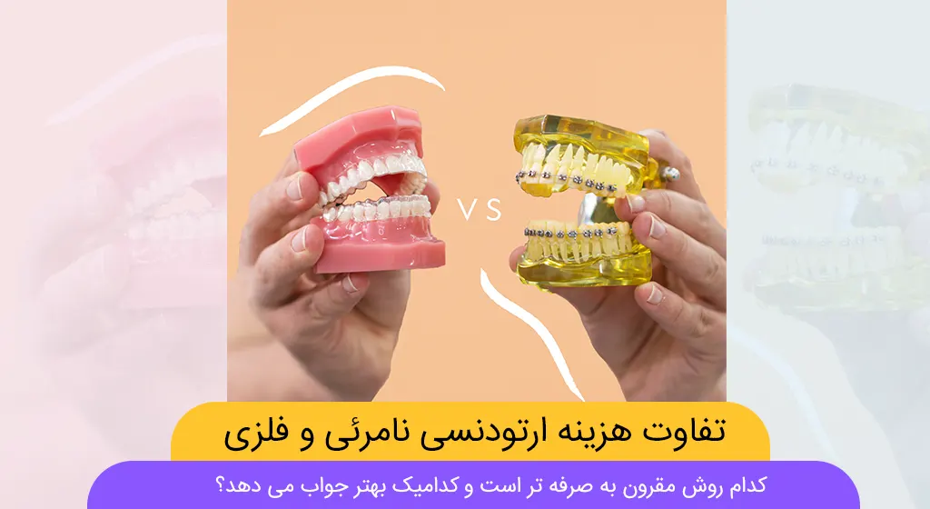 تفاوت هزینه ارتودنسی نامرئی و فلزی شاخص