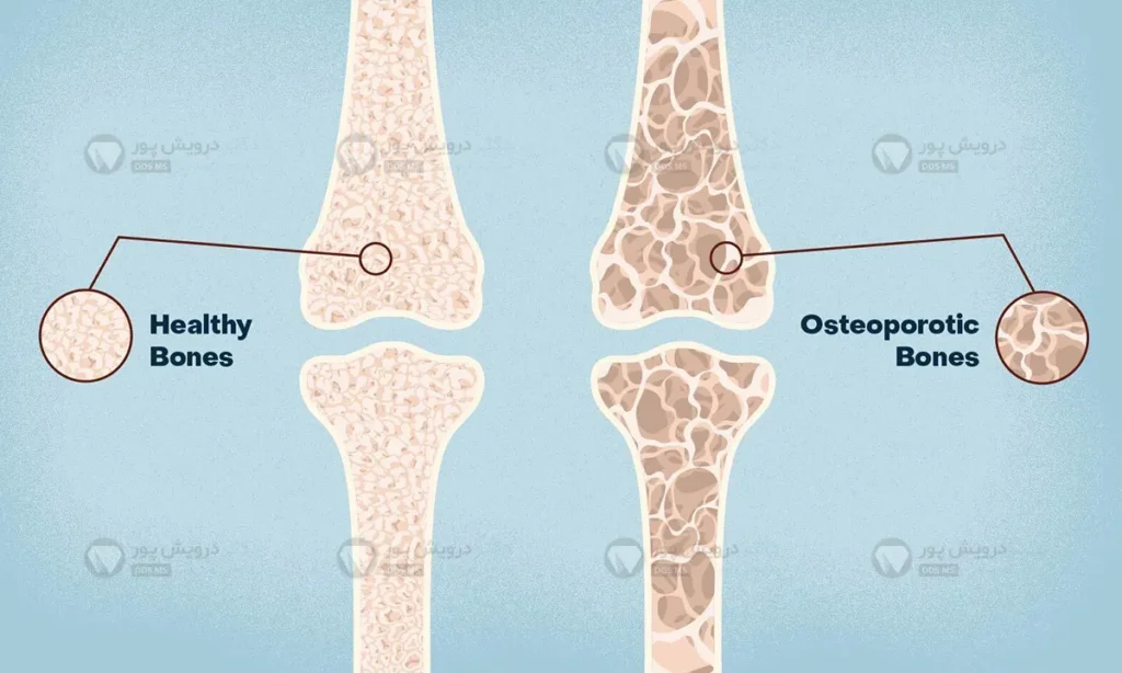 پوکی استخوان های بدن