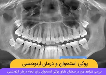 ارتودنسی و پوکی استخوان