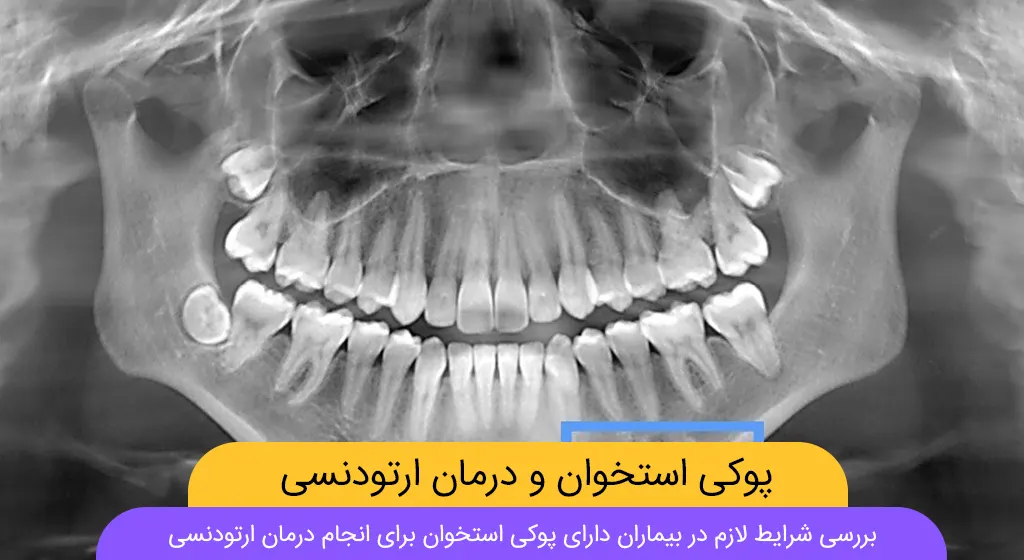 ارتودنسی و پوکی استخوان