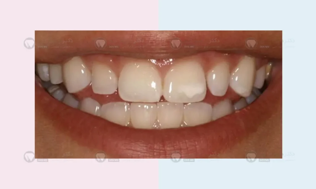تصویر دندان هایی که دچار دمینرالیزاسیون شده اند