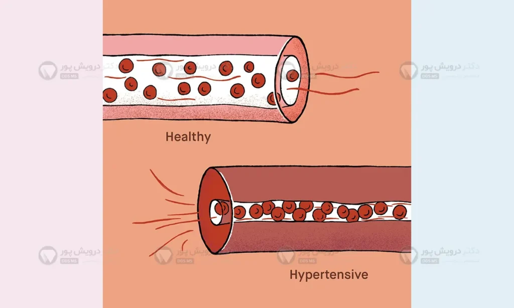 مشکل فشار خون بالا