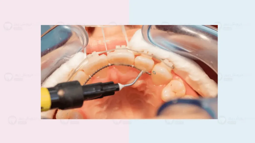 برداشتن فیکس ریتینر