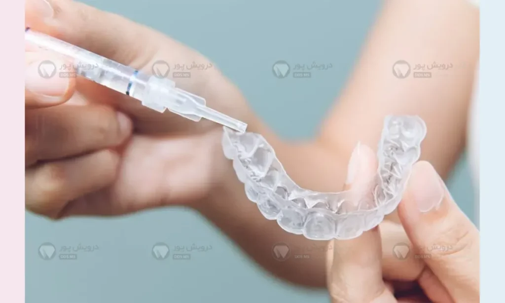 بلیچینگ در زمان ارتودنسی نامرئی