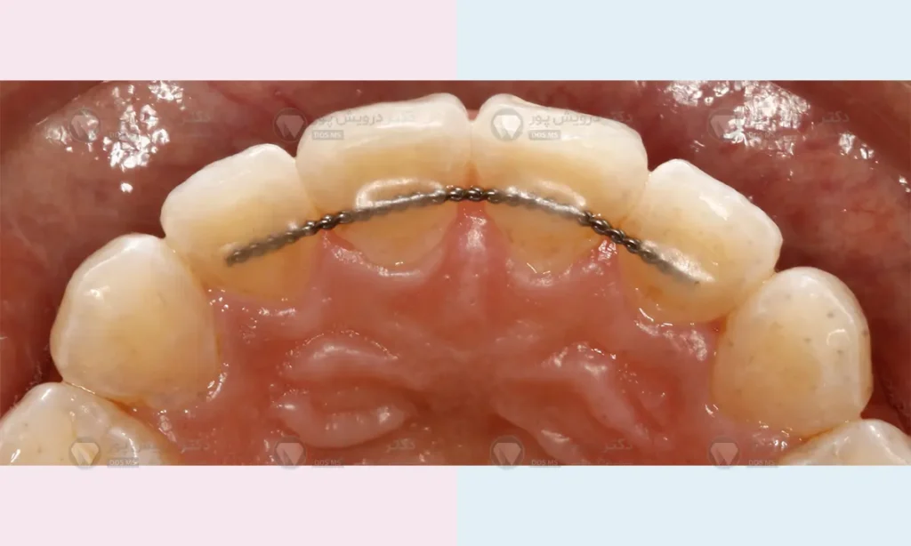 عکس نگهدارنده ارتودنسی دندان