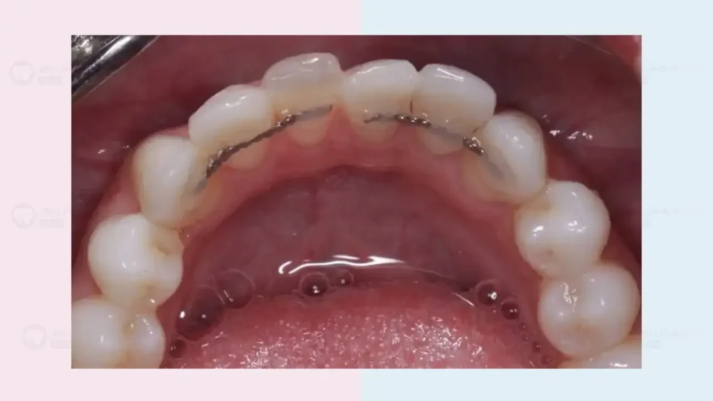 شکستن فیکس ریتینر ارتودنسی