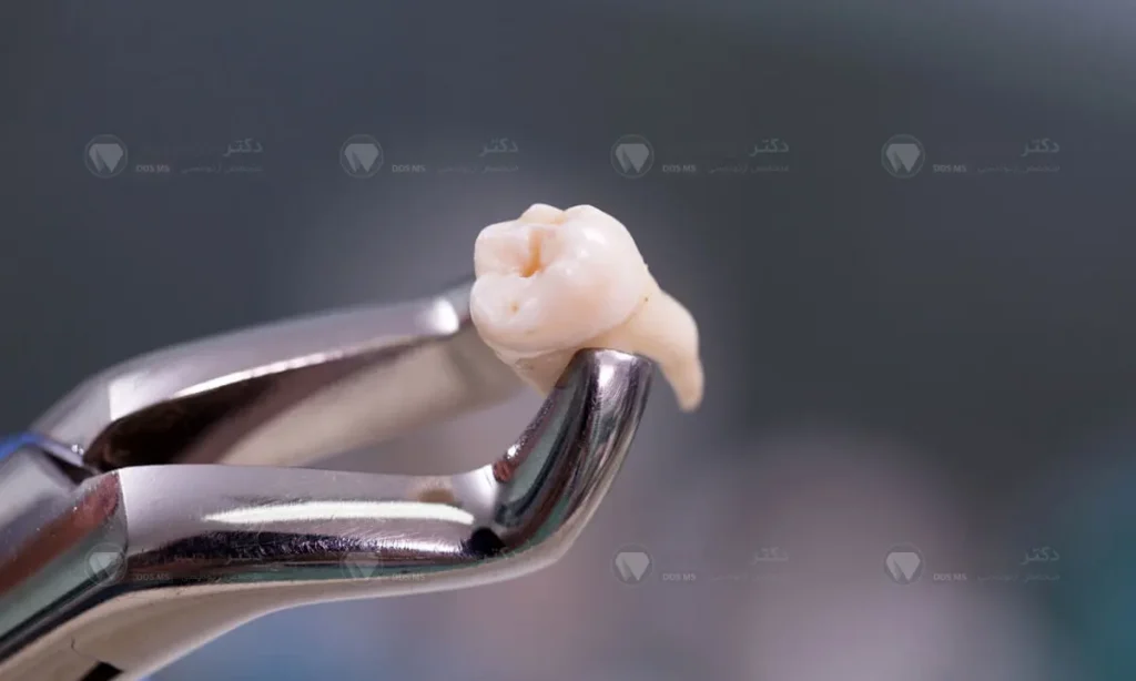 عکس دندان عقلی که به تازگی کشیده شده