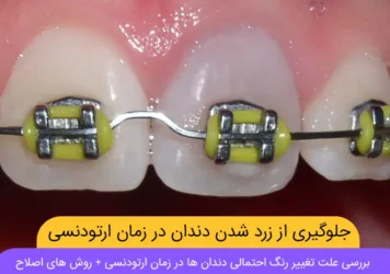 جلوگیری زرد شدن دندان ها در زمان ارتودنسی دندان