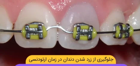 جلوگیری زرد شدن دندان ها در زمان ارتودنسی دندان