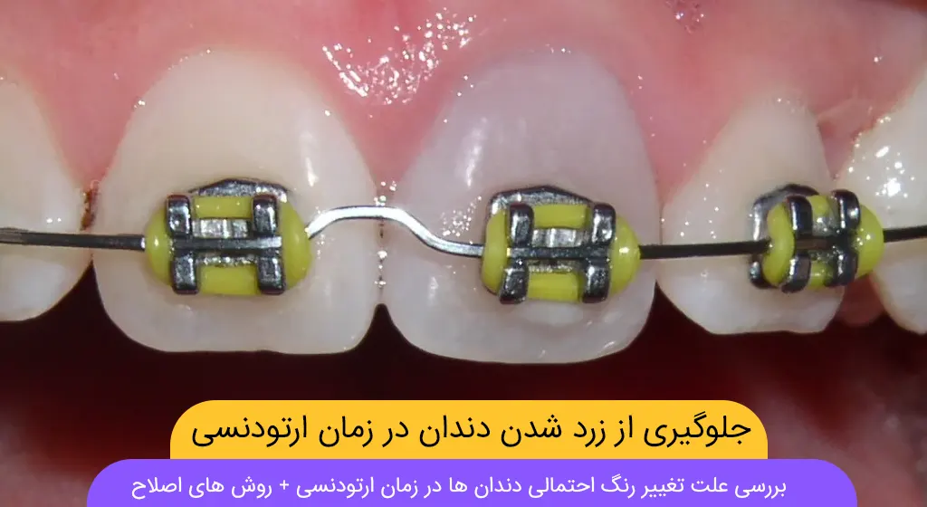 جلوگیری زرد شدن دندان ها در زمان ارتودنسی دندان