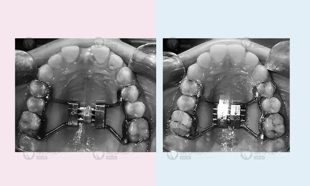 عکس قبل  و بعد از هایرکس