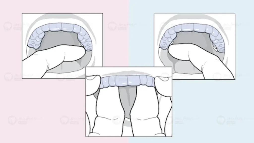 نحوه صحیح برداشتن الاینرها