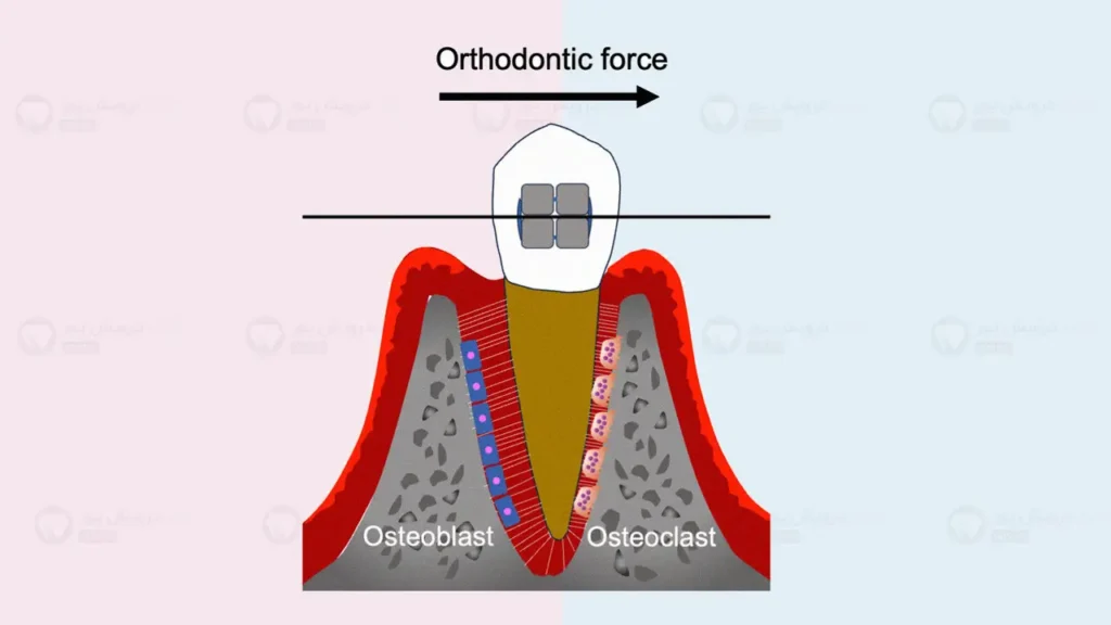 نیروی ارتودنسی و فرآیند تخریب + بازسازی در اطراف دندان