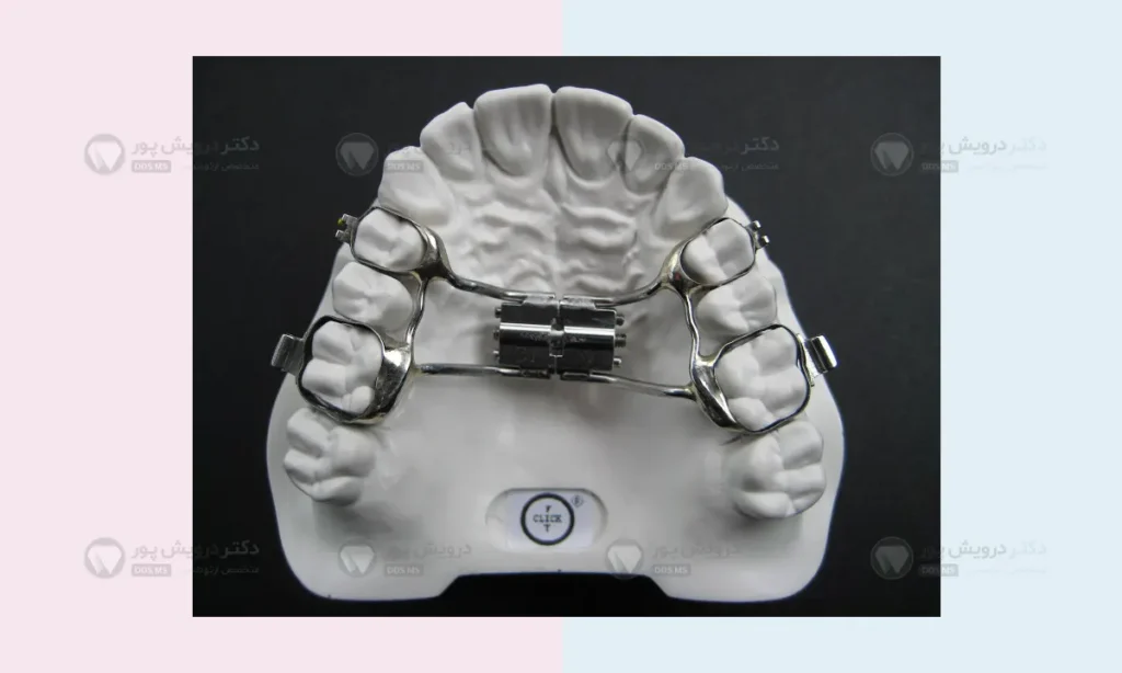 عکس هایرکس فلزی ارتودنسی 