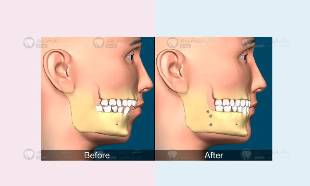 جراحی اوربایت