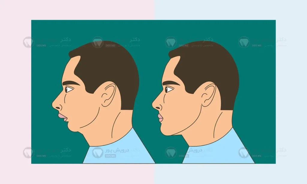 حالت لب در اوربایت