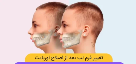 تغییر فرم چانه بعد از اصلاح اوربایت با ارتودنسی شاخص