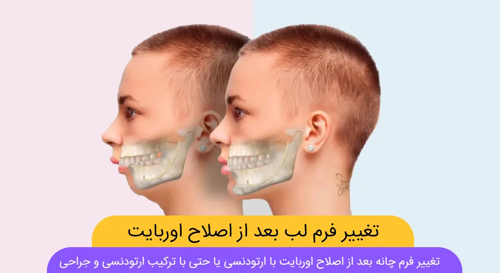تغییر فرم چانه بعد از اصلاح اوربایت با ارتودنسی شاخص