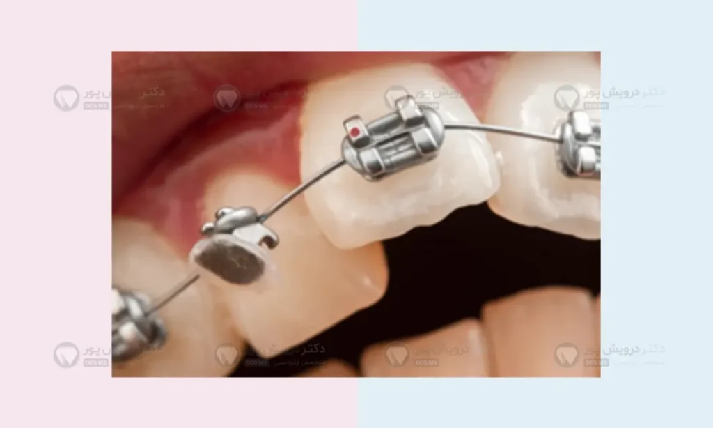 براکت ارتودنسی دندان