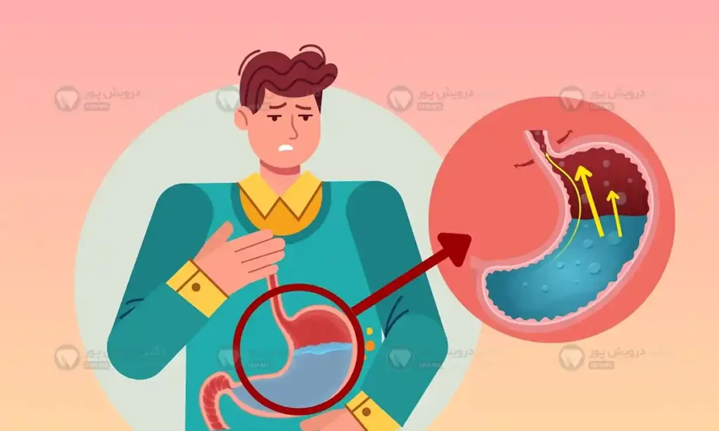 رفلاکس اسید معده