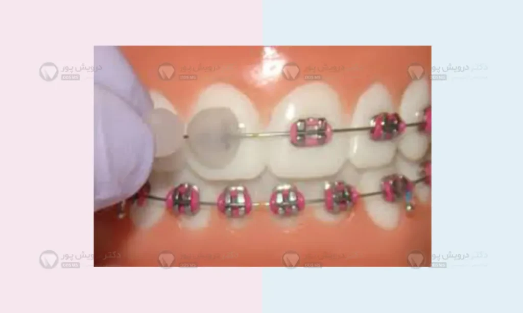 موم ارتودنسی