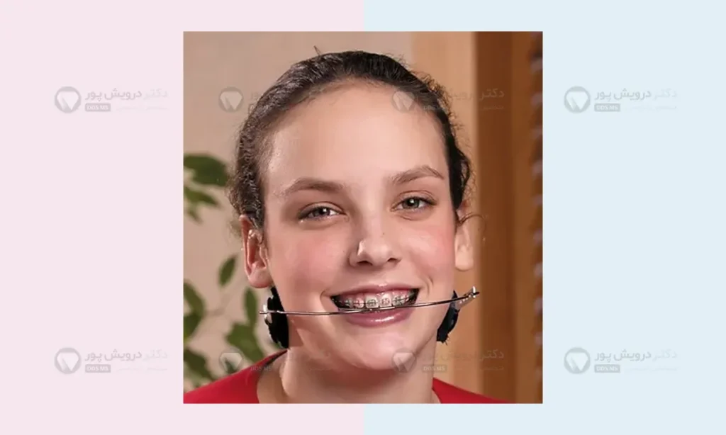 هدگیر ارتودنسی عکس