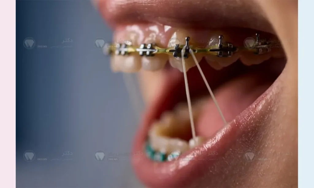 کش ارتودنسی مثلثی