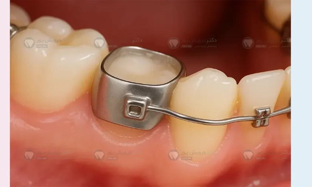 عکس بند ارتودنسی دندان