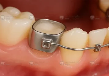 عکس بند ارتودنسی دندان