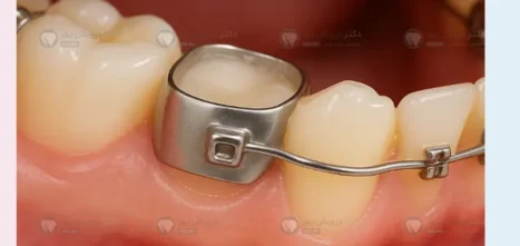 عکس بند ارتودنسی دندان